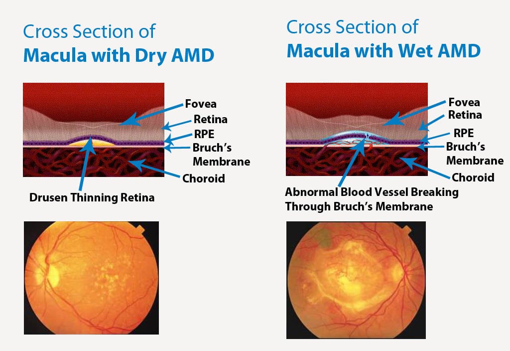 wet vs dry macular degeneration