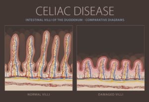 celiac disease and absorption