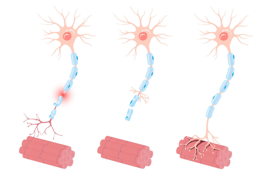 Peripheral neuropathy illustration