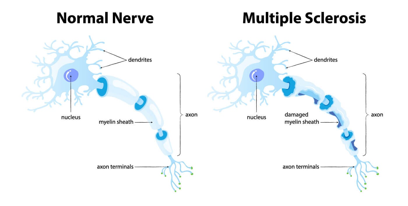 normal nerve vs multiple sclerosis